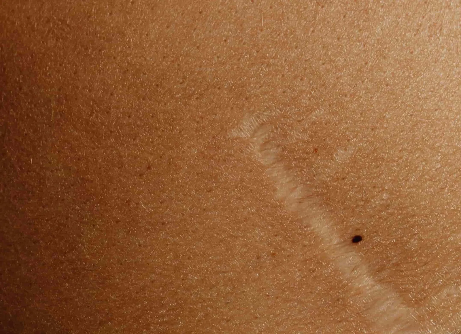 Can dry fasting heal streatch marks and loose skin - Scar